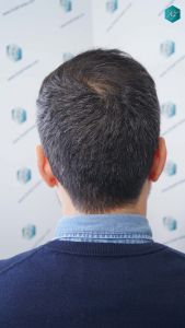 Injerto Capilar Técnica FUE Grafts 4.516 (11.888 Pelos) 51 61 RESULTADOS A LOS 9 MESES