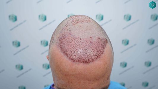 Injerto Capilar Técnica FUE Grafts 4924 (11170 Pelos) 53 61 TRASPLANTE CAPILAR