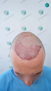 Injerto Capilar Técnica FUE Grafts 4924 (11170 Pelos) 54 62 TRASPLANTE CAPILAR