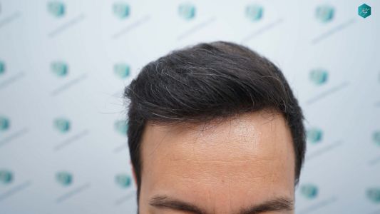 Injerto Capilar Técnica FUE Grafts 4.516 (11.888 Pelos) 52 63 RESULTADOS A LOS 12 MESES