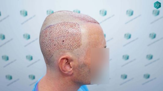 Injerto Capilar Técnica FUE Grafts 4924 (11170 Pelos) 25 63 TRASPLANTE CAPILAR