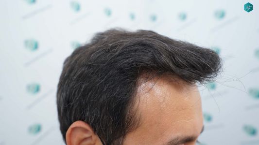 Injerto Capilar Técnica FUE Grafts 4.516 (11.888 Pelos) 53 64 RESULTADOS A LOS 12 MESES