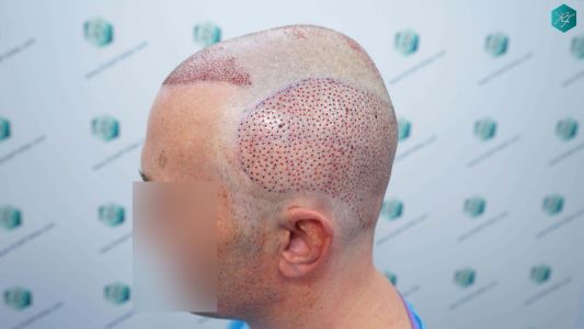 Injerto Capilar Técnica FUE Grafts 4924 (11170 Pelos) 26 64 TRASPLANTE CAPILAR