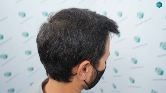 Injerto Capilar Técnica FUE Grafts 4.516 (11.888 Pelos) 54 64A RESULTADOS A LOS 12 MESES