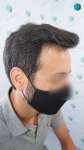 Injerto Capilar Técnica FUE Grafts 4.516 (11.888 Pelos) 55 65 RESULTADOS A LOS 12 MESES