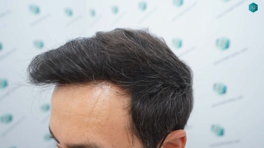 Injerto Capilar Técnica FUE Grafts 4.516 (11.888 Pelos) 56 66 RESULTADOS A LOS 12 MESES