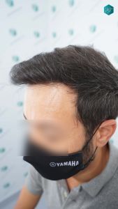 Injerto Capilar Técnica FUE Grafts 4.516 (11.888 Pelos) 57 67 RESULTADOS A LOS 12 MESES