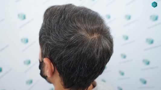 Injerto Capilar Técnica FUE Grafts 4.516 (11.888 Pelos) 58 67A RESULTADOS A LOS 12 MESES