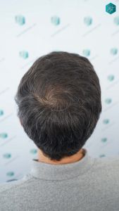 Injerto Capilar Técnica FUE Grafts 4.516 (11.888 Pelos) 59 68 RESULTADOS A LOS 12 MESES 1