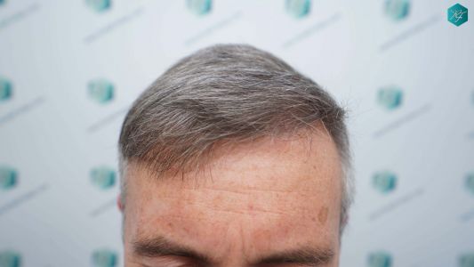 Injerto Capilar Técnica FUE Grafts 4924 (11170 Pelos) 57 68 RESULTADOS A LOS 12 MESES