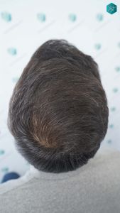 Injerto Capilar Técnica FUE Grafts 4.516 (11.888 Pelos) 60 68A RESULTADOS A LOS 12 MESES 1