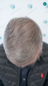 Injerto Capilar Técnica FUE Grafts 4924 (11170 Pelos) 58 68A RESULTADOS A LOS 12 MESES