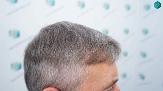 Injerto Capilar Técnica FUE Grafts 4924 (11170 Pelos) 59 69 RESULTADOS A LOS 12 MESES