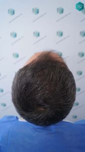 Injerto Capilar Técnica FUE Grafts 3362 (8806 Pelos) 5 7 ANTES DEL TRASPLANTE CAPILAR 1