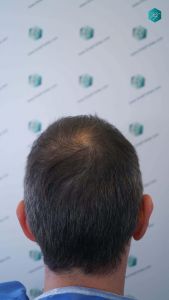 Injerto Capilar Técnica FUE Grafts 4924 (11170 Pelos) 5 7 ANTES DEL TRASPLANTE CAPILAR