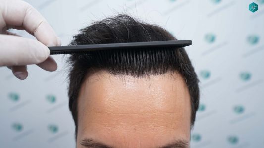 Injerto Capilar Técnica FUE Grafts 4.516 (11.888 Pelos) 61 70 RESULTADOS A LOS 12 MESES 1