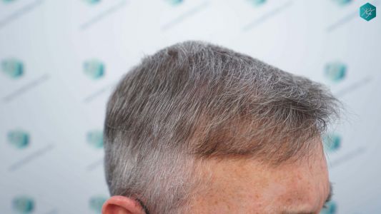 Injerto Capilar Técnica FUE Grafts 4924 (11170 Pelos) 60 70 RESULTADOS A LOS 12 MESES