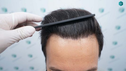 Injerto Capilar Técnica FUE Grafts 4.516 (11.888 Pelos) 62 71 RESULTADOS A LOS 12 MESES 1