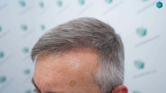 Injerto Capilar Técnica FUE Grafts 4924 (11170 Pelos) 61 71 RESULTADOS A LOS 12 MESES