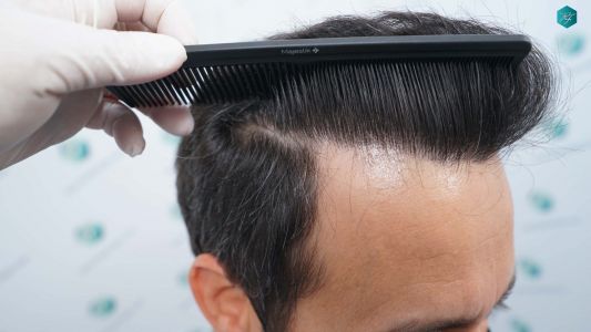 Injerto Capilar Técnica FUE Grafts 4.516 (11.888 Pelos) 63 72 RESULTADOS A LOS 12 MESES 1