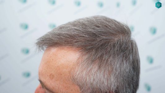 Injerto Capilar Técnica FUE Grafts 4924 (11170 Pelos) 62 72 RESULTADOS A LOS 12 MESES