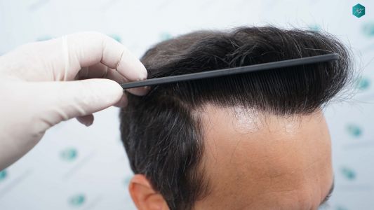 Injerto Capilar Técnica FUE Grafts 4.516 (11.888 Pelos) 64 72A RESULTADOS A LOS 12 MESES 1
