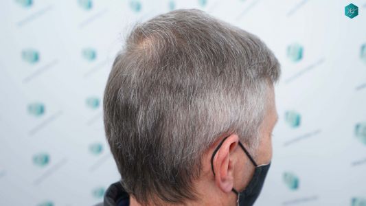 Injerto Capilar Técnica FUE Grafts 4924 (11170 Pelos) 63 72A RESULTADOS A LOS 12 MESES
