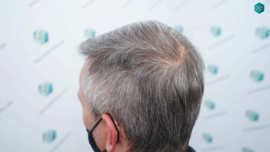 Injerto Capilar Técnica FUE Grafts 4924 (11170 Pelos) 64 72B RESULTADOS A LOS 12 MESES