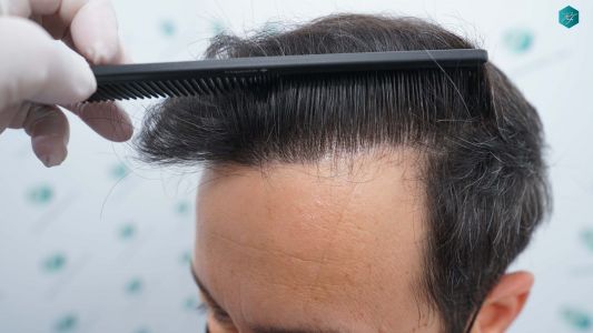 Injerto Capilar Técnica FUE Grafts 4.516 (11.888 Pelos) 65 73 RESULTADOS A LOS 12 MESES 1