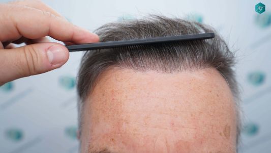 Injerto Capilar Técnica FUE Grafts 4924 (11170 Pelos) 65 73 RESULTADOS A LOS 12 MESES