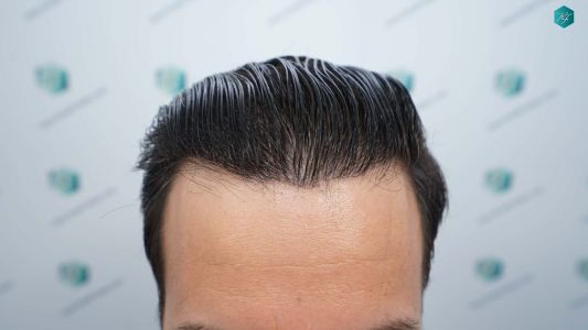 Injerto Capilar Técnica FUE Grafts 4.516 (11.888 Pelos) 66 74 RESULTADOS A LOS 12 MESES 1