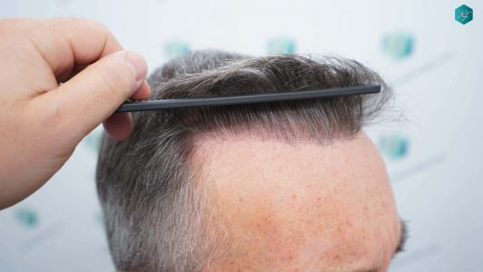 Injerto Capilar Técnica FUE Grafts 4924 (11170 Pelos) 66 74 RESULTADOS A LOS 12 MESES
