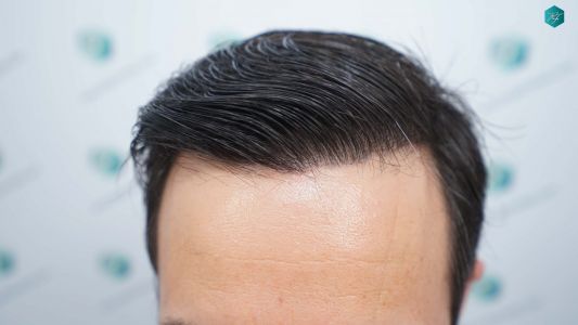 Injerto Capilar Técnica FUE Grafts 4.516 (11.888 Pelos) 67 74A RESULTADOS A LOS 12 MESES