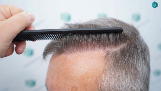 Injerto Capilar Técnica FUE Grafts 4924 (11170 Pelos) 67 75 RESULTADOS A LOS 12 MESES