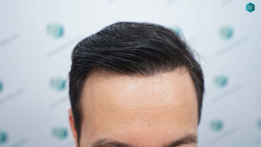 Injerto Capilar Técnica FUE Grafts 4.516 (11.888 Pelos) 69 76 RESULTADOS A LOS 12 MESES 1