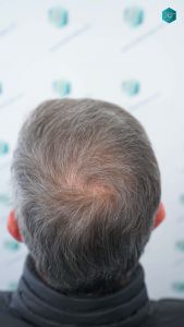 Injerto Capilar Técnica FUE Grafts 4924 (11170 Pelos) 68 76 RESULTADOS A LOS 12 MESES