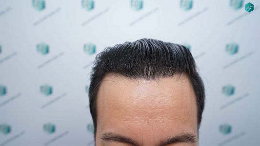 Injerto Capilar Técnica FUE Grafts 4.516 (11.888 Pelos) 70 77 RESULTADOS A LOS 12 MESES
