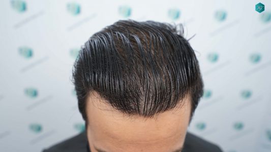 Injerto Capilar Técnica FUE Grafts 4.516 (11.888 Pelos) 71 78 RESULTADOS A LOS 12 MESES