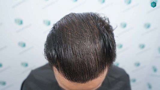Injerto Capilar Técnica FUE Grafts 4.516 (11.888 Pelos) 72 78A RESULTADOS A LOS 12 MESES