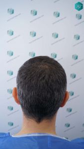 Injerto Capilar Técnica FUE Grafts 3362 (8806 Pelos) 6 8 ANTES DEL TRASPLANTE CAPILAR 1