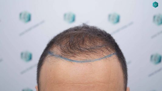 DISEÑO LINEA DE INJERTO 8 DISENO LINEA DE INJERTO