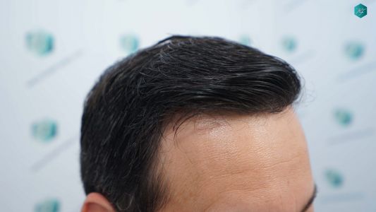 Injerto Capilar Técnica FUE Grafts 4.516 (11.888 Pelos) 73 80 RESULTADOS A LOS 12 MESES