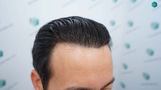 Injerto Capilar Técnica FUE Grafts 4.516 (11.888 Pelos) 74 80A RESULTADOS A LOS 12 MESES