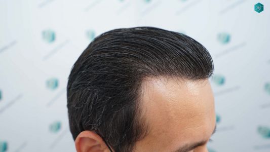 Injerto Capilar Técnica FUE Grafts 4.516 (11.888 Pelos) 75 81 RESULTADOS A LOS 12 MESES