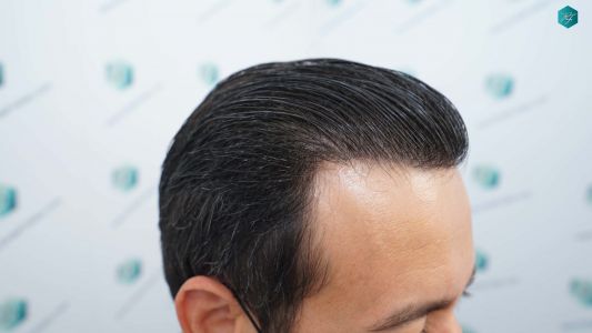 Injerto Capilar Técnica FUE Grafts 4.516 (11.888 Pelos) 76 82 RESULTADOS A LOS 12 MESES
