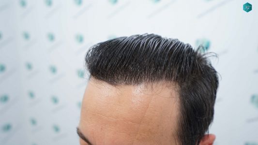Injerto Capilar Técnica FUE Grafts 4.516 (11.888 Pelos) 77 83 RESULTADOS A LOS 12 MESES