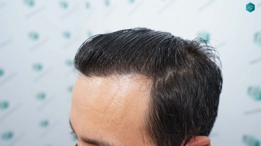 Injerto Capilar Técnica FUE Grafts 4.516 (11.888 Pelos) 78 84 RESULTADOS A LOS 12 MESES