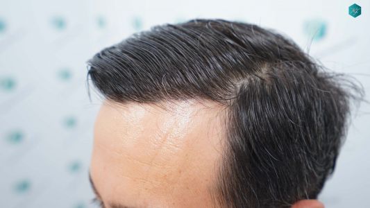 Injerto Capilar Técnica FUE Grafts 4.516 (11.888 Pelos) 79 85 RESULTADOS A LOS 12 MESES