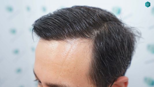 Injerto Capilar Técnica FUE Grafts 4.516 (11.888 Pelos) 80 86 RESULTADOS A LOS 12 MESES