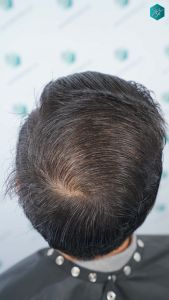 Injerto Capilar Técnica FUE Grafts 4.516 (11.888 Pelos) 82 87A RESULTADOS A LOS 12 MESES